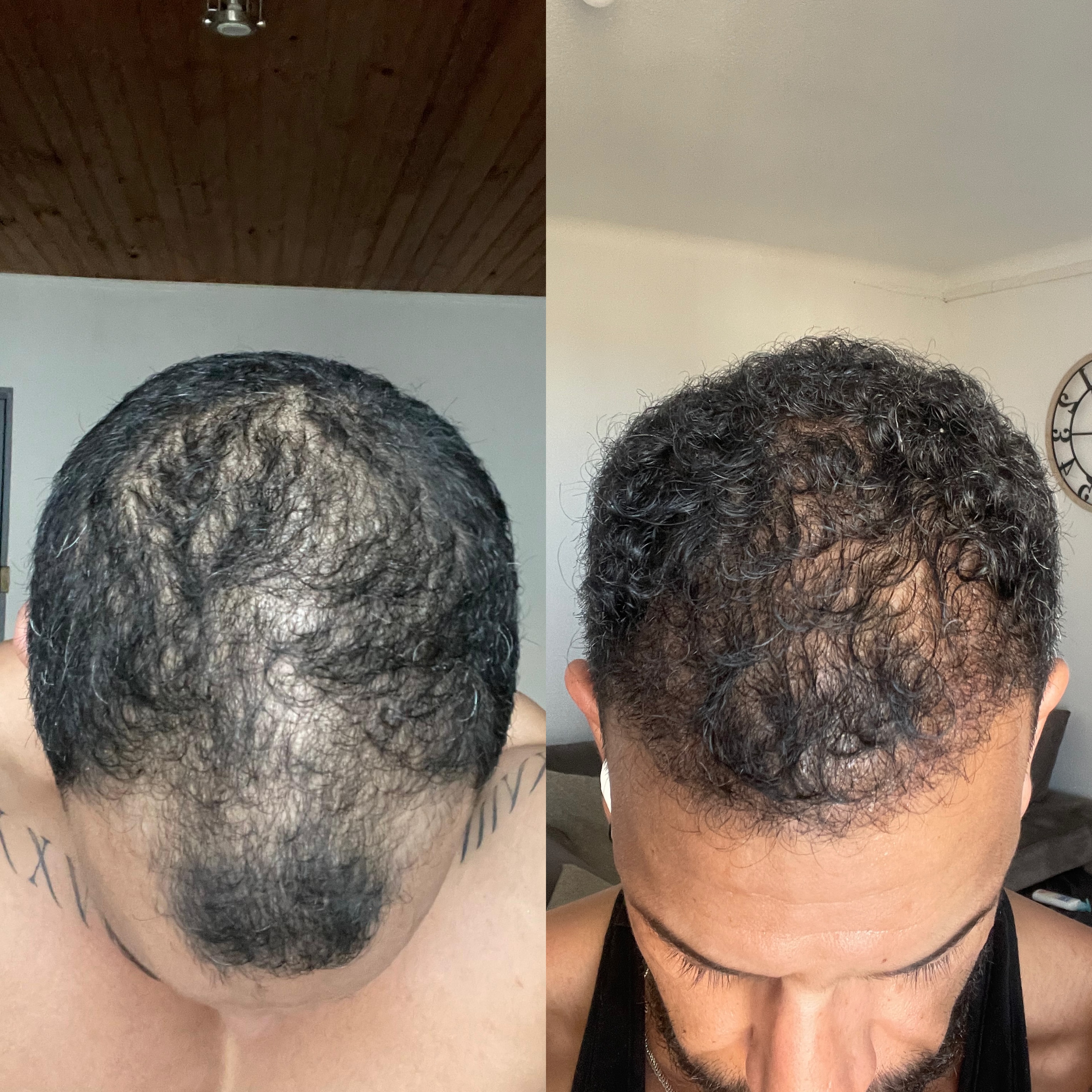 Résultat avant et après greffe de cheveux