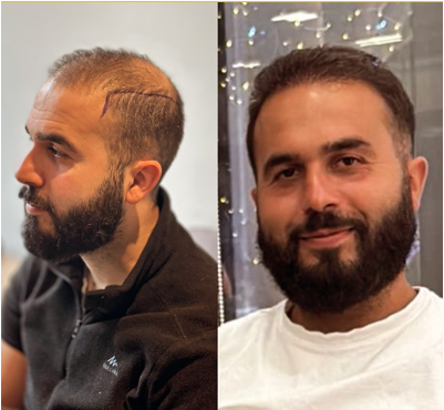 Résultat avant et après greffe de cheveux