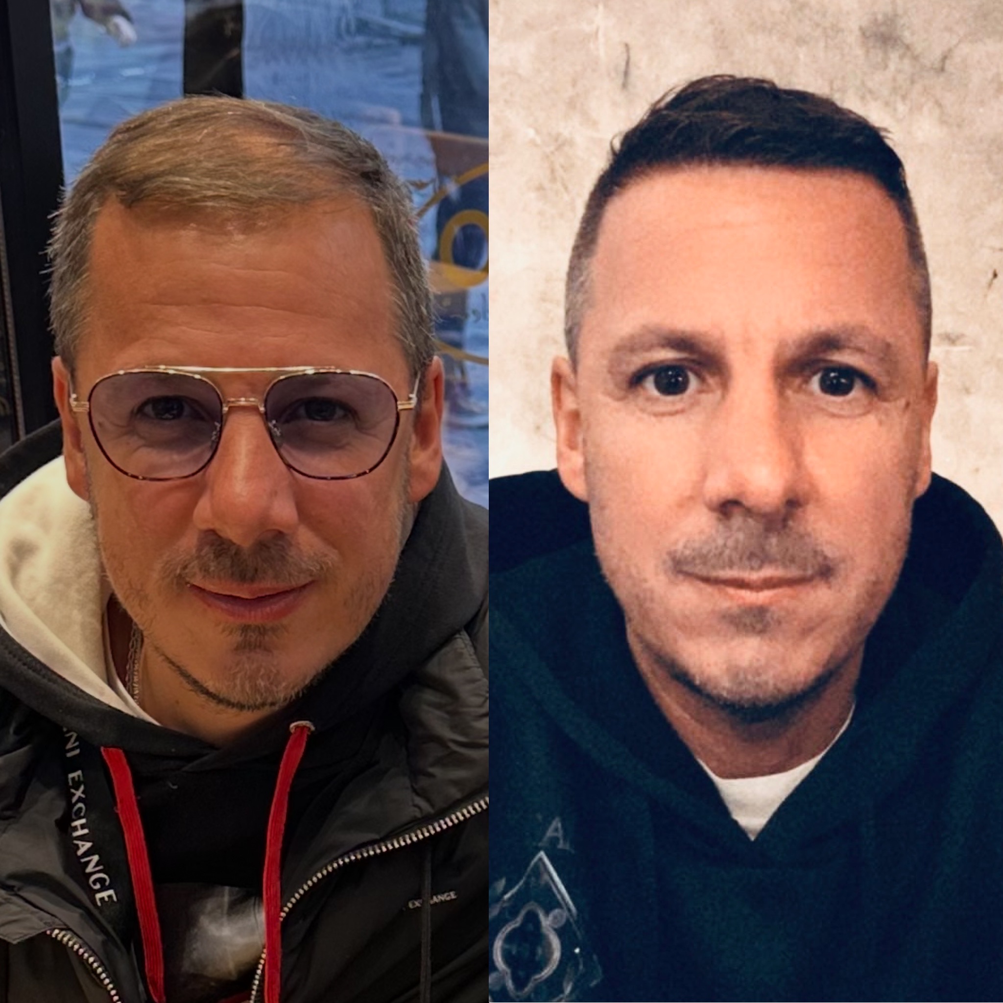 Résultat avant et après greffe de cheveux