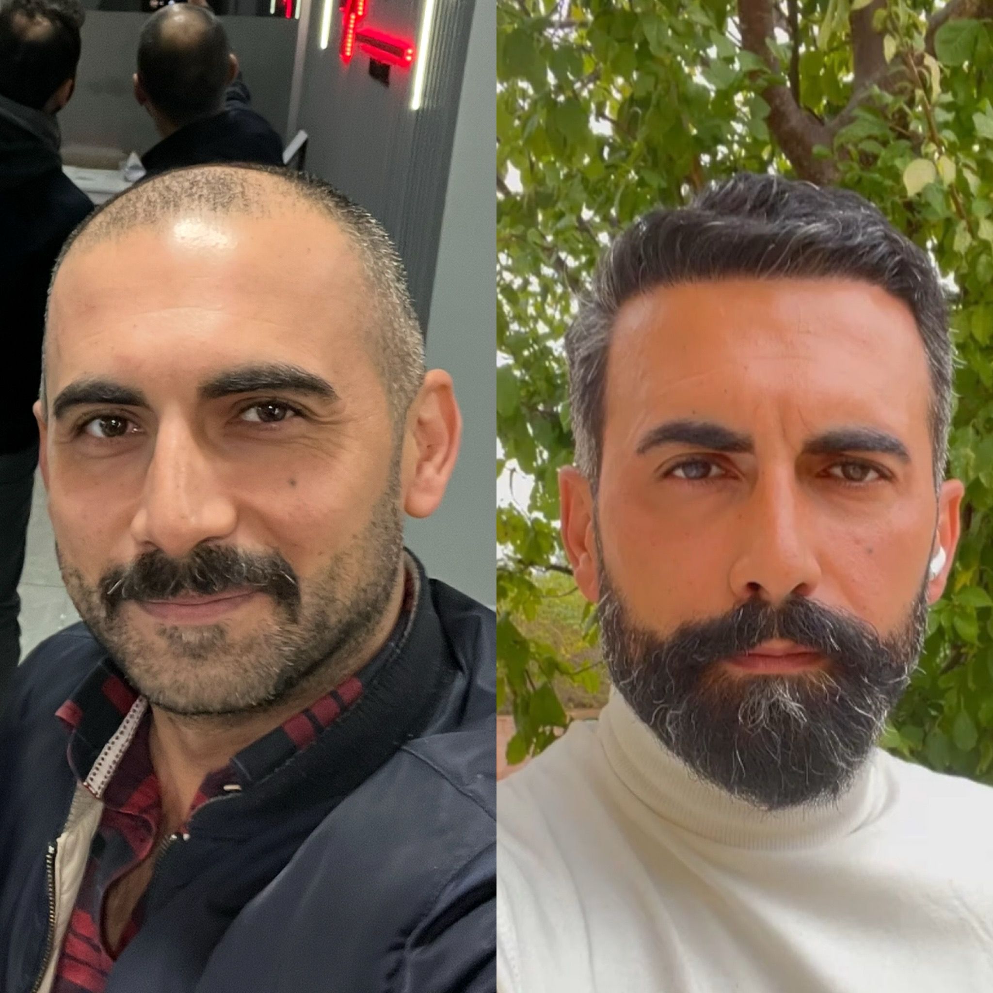 Résultat avant et après greffe de cheveux