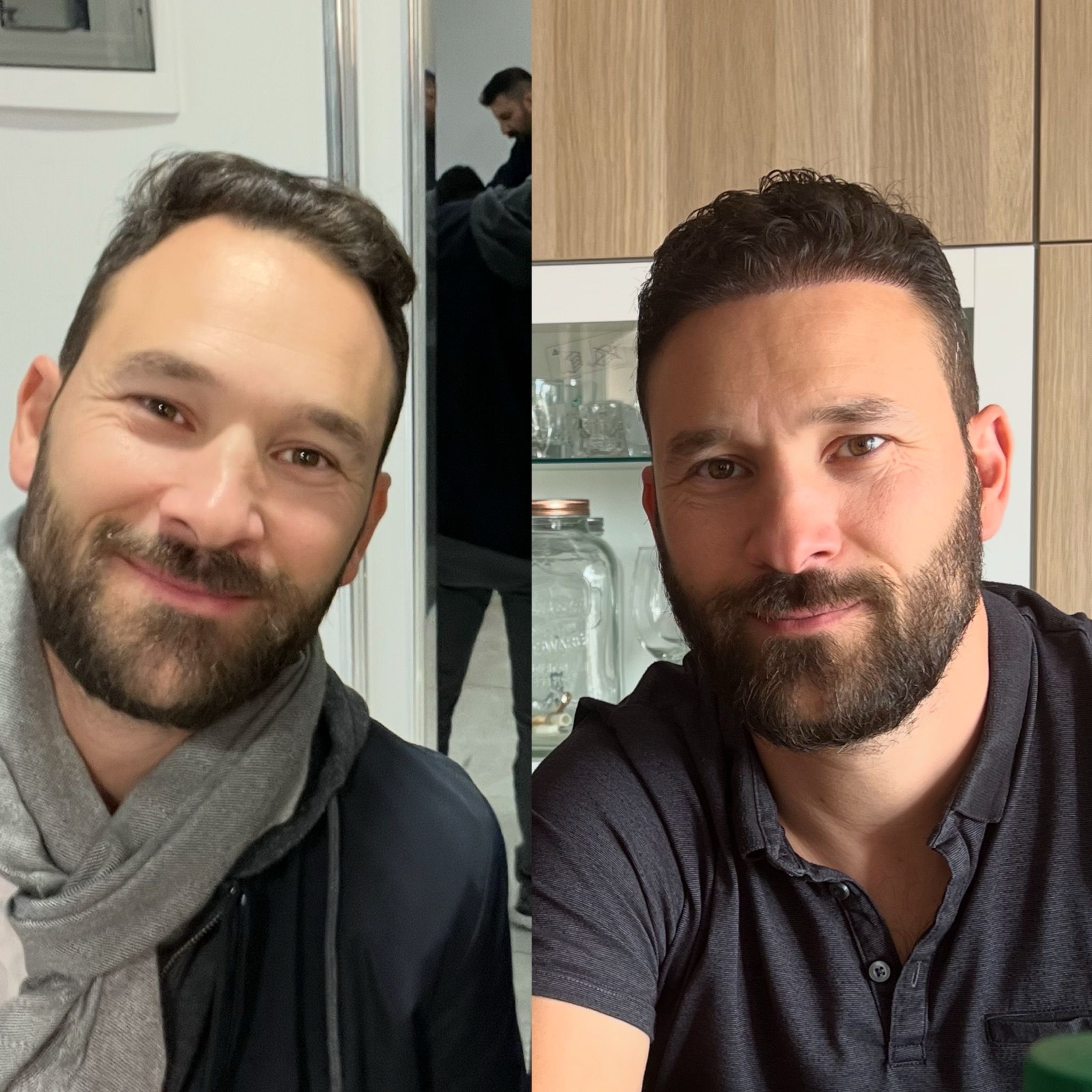 Résultat avant et après greffe de cheveux